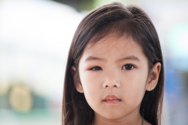 Closeup of asian child girl eye swell from bacteria virus